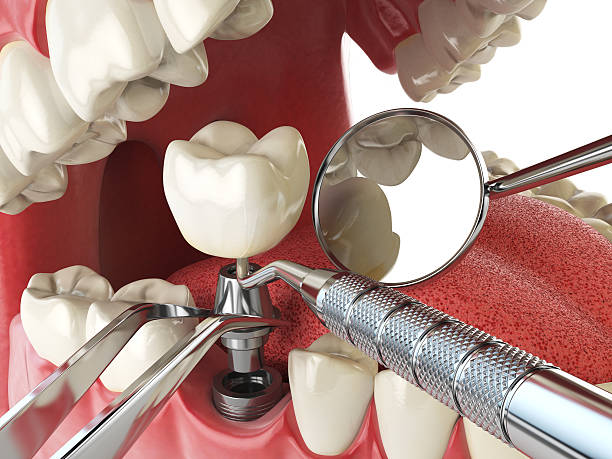 Best Emergency Dentist for Lost Fillings or Crowns in Lost Hills, CA